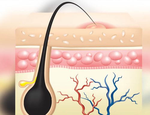 Kıl Dönmesi (Pilonidal Sinüs) Nasıl Anlaşılır?