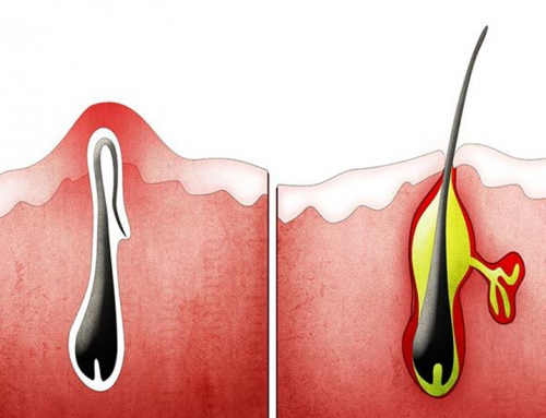 Kıl Dönmesi (Pilonidal Sinüs) Nedenleri