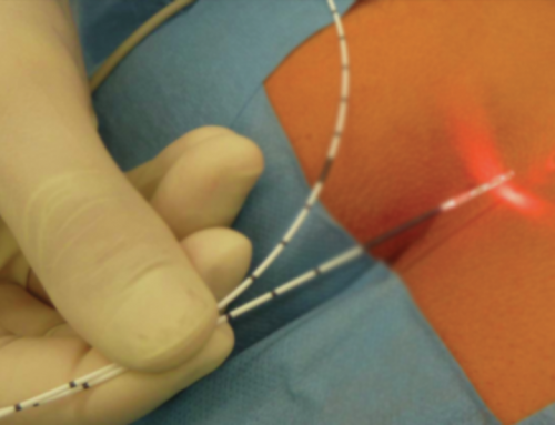 Kıl Dönmesi (Pilonidal Sinüs) Tedavisi