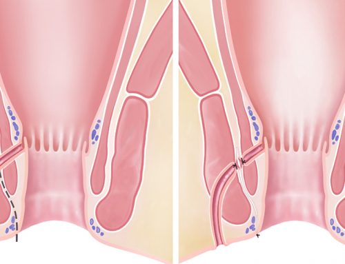 Ataşehir Anal Fistül Cerrahisi – Tedavisi – Doktoru