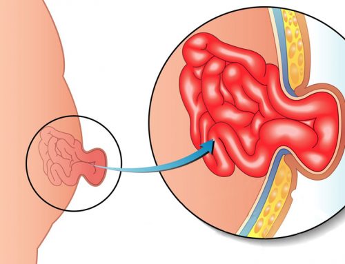Göbek Fıtığı Nedir ve Belirtileri Nelerdir?