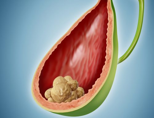 Safra Kesesi Taşı Belirtileri Nelerdir?